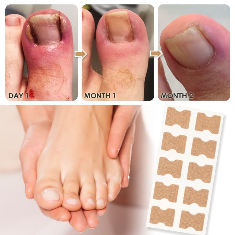 🔥Hot Sale ✨ UP TO 65% OFF🔥 Toenail Corrector Patch (Buy More, Save More)