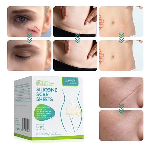 Soft Silicone Gel Tape for Scar Removal (1.6” x 60”)