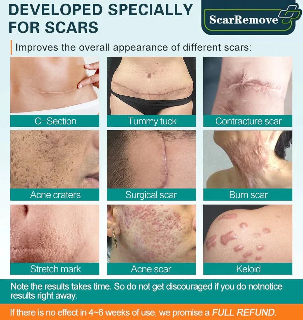 ❤️ScarRemove™ Advanced Scar Spray For All Types of Scars - For example Acne Scars. Surgical Scars and Stretch Marks ⚡️⚡️⚡️